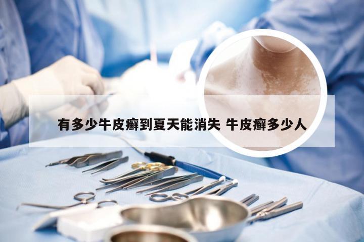 有多少牛皮癣到夏天能消失 牛皮癣多少人