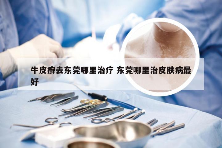 牛皮癣去东莞哪里治疗 东莞哪里治皮肤病最好