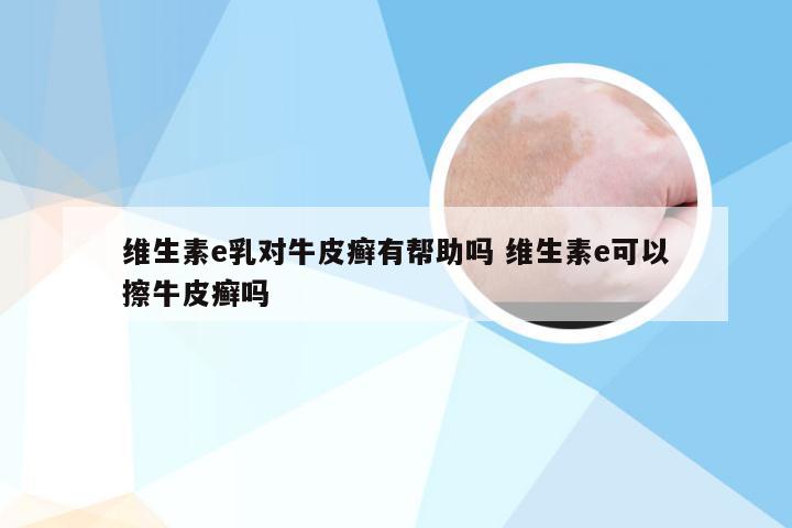 维生素e乳对牛皮癣有帮助吗 维生素e可以擦牛皮癣吗