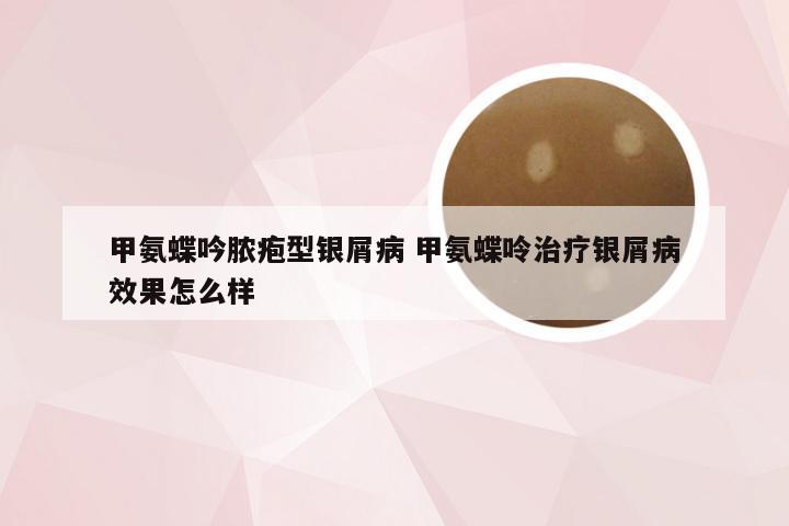 甲氨蝶吟脓疱型银屑病 甲氨蝶呤治疗银屑病效果怎么样