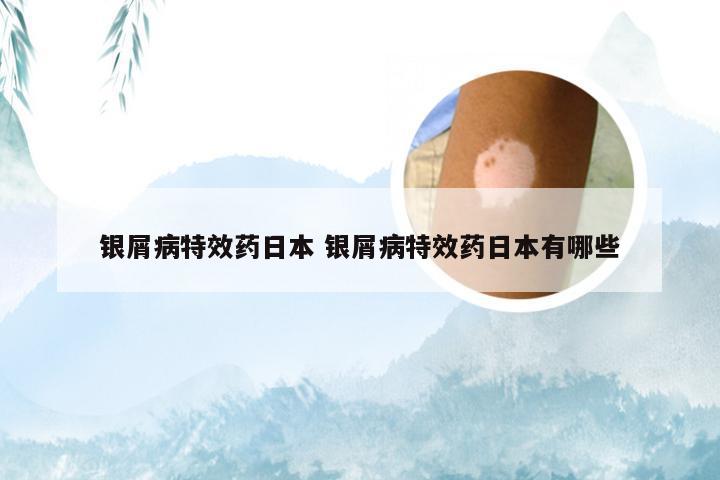 银屑病特效药日本 银屑病特效药日本有哪些