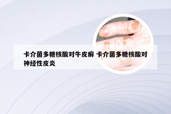 卡介菌多糖核酸对牛皮癣 卡介菌多糖核酸对神经性皮炎