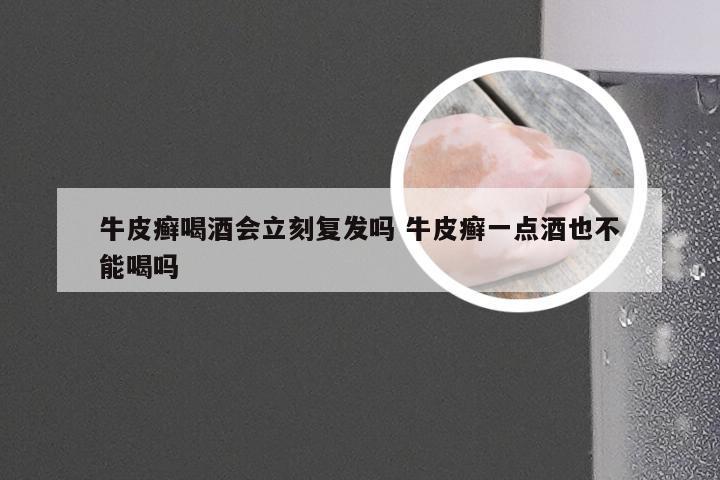 牛皮癣喝酒会立刻复发吗 牛皮癣一点酒也不能喝吗