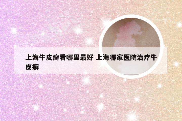 上海牛皮癣看哪里最好 上海哪家医院治疗牛皮癣