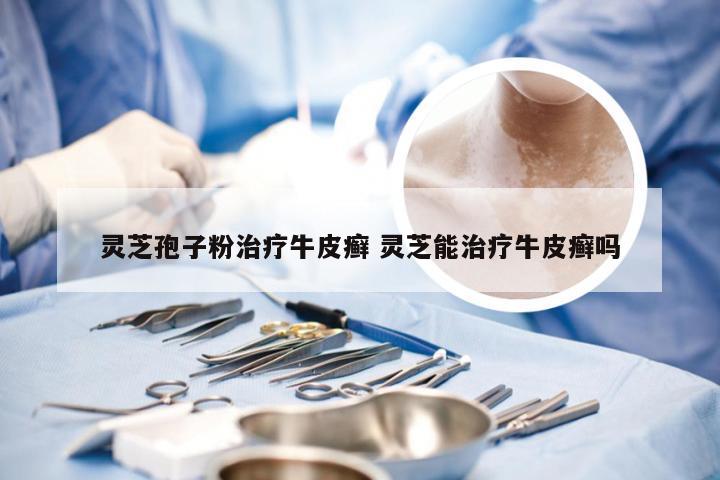 灵芝孢子粉治疗牛皮癣 灵芝能治疗牛皮癣吗