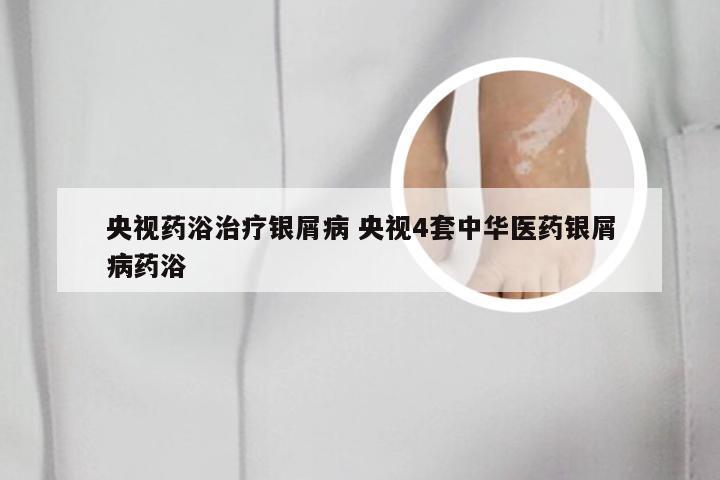 央视药浴治疗银屑病 央视4套中华医药银屑病药浴
