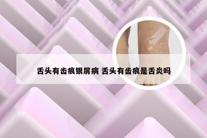 舌头有齿痕银屑病 舌头有齿痕是舌炎吗