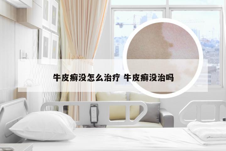 牛皮癣没怎么治疗 牛皮癣没治吗