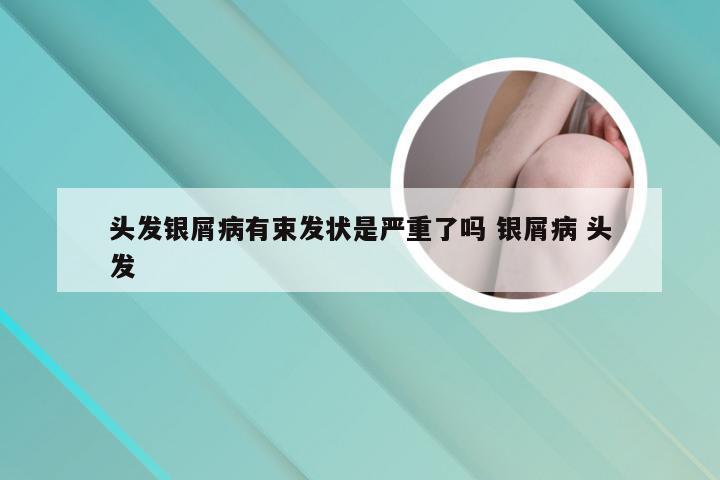 头发银屑病有束发状是严重了吗 银屑病 头发
