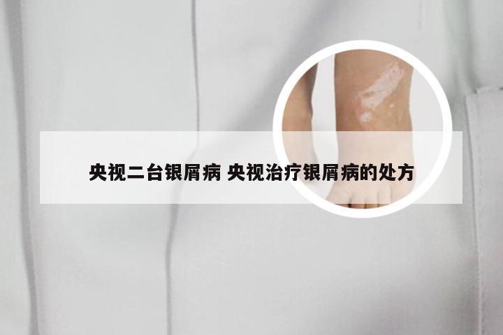 央视二台银屑病 央视治疗银屑病的处方