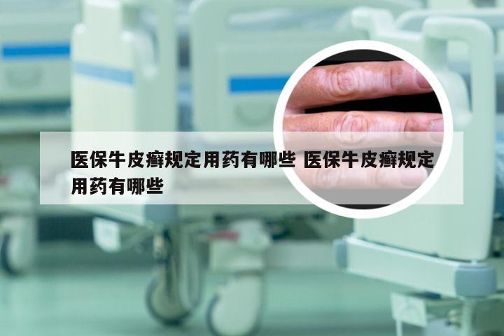 医保牛皮癣规定用药有哪些 医保牛皮癣规定用药有哪些