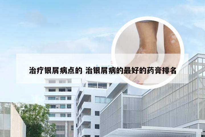 治疗银屑病点的 治银屑病的最好的药膏排名