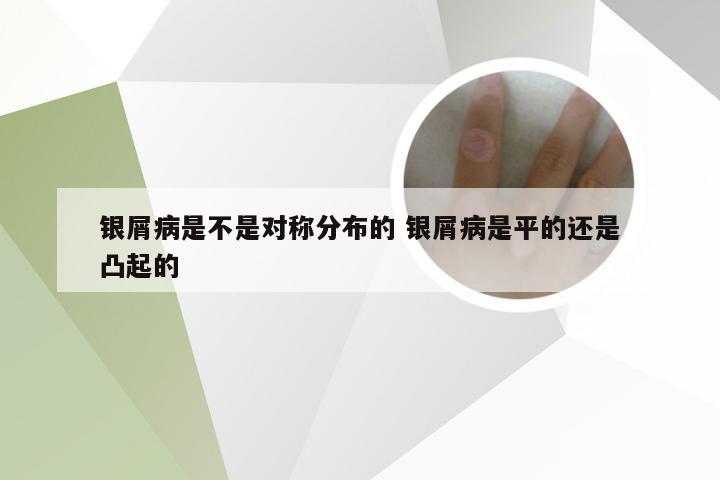 银屑病是不是对称分布的 银屑病是平的还是凸起的