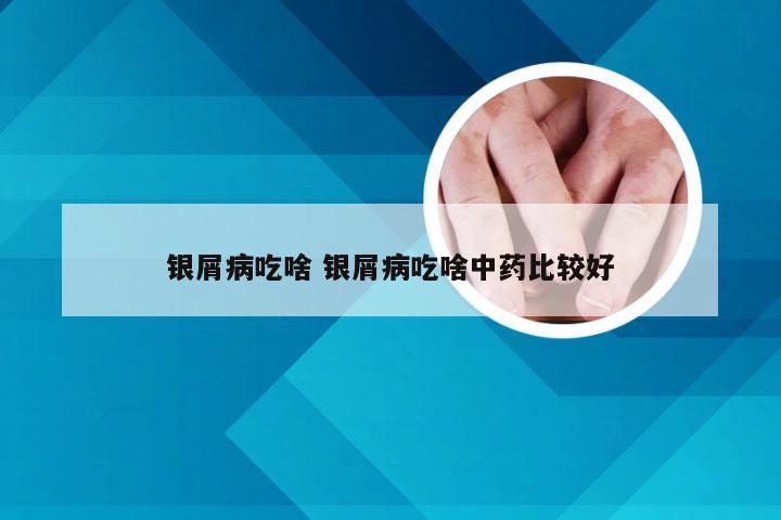 银屑病吃啥 银屑病吃啥中药比较好