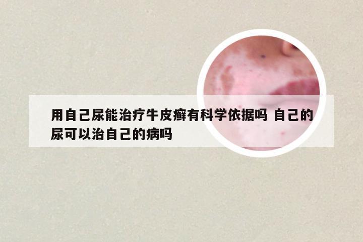 用自己尿能治疗牛皮癣有科学依据吗 自己的尿可以治自己的病吗