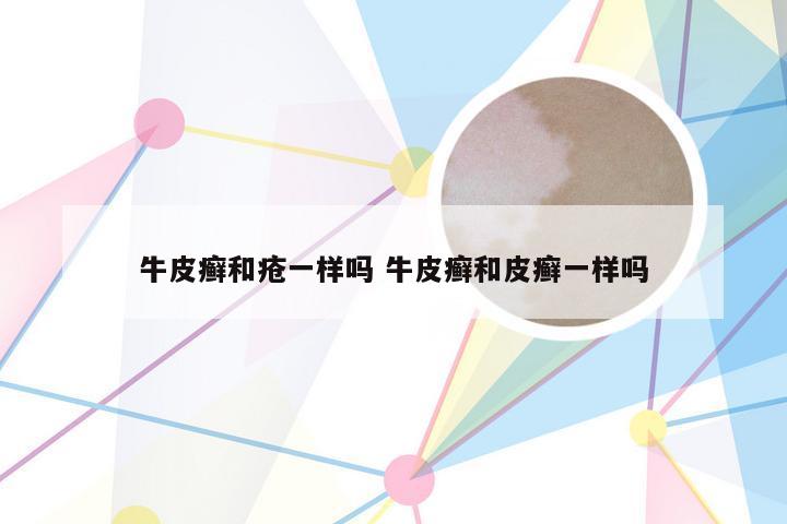 牛皮癣和疮一样吗 牛皮癣和皮癣一样吗
