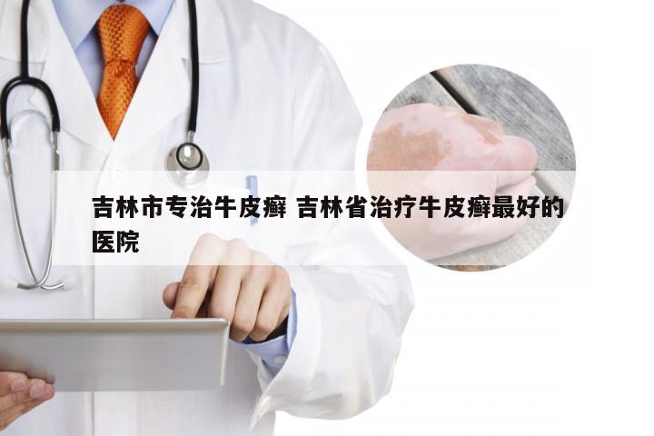 吉林市专治牛皮癣 吉林省治疗牛皮癣最好的医院