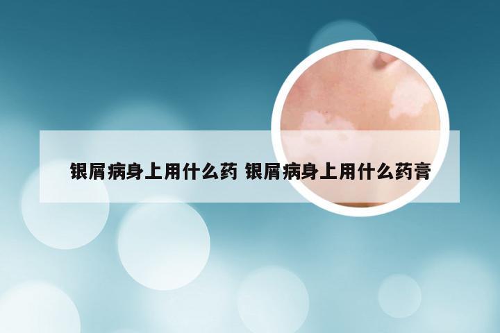 银屑病身上用什么药 银屑病身上用什么药膏