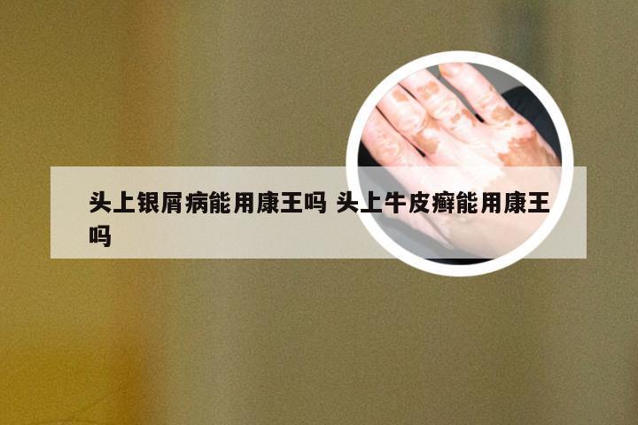 头上银屑病能用康王吗 头上牛皮癣能用康王吗