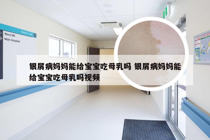 银屑病妈妈能给宝宝吃母乳吗 银屑病妈妈能给宝宝吃母乳吗视频