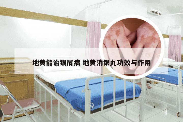 地黄能治银屑病 地黄消银丸功效与作用