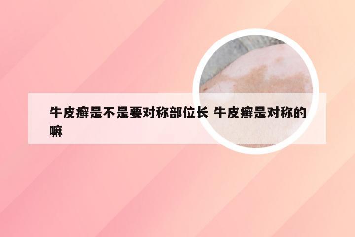 牛皮癣是不是要对称部位长 牛皮癣是对称的嘛