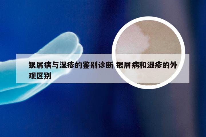 银屑病与湿疹的鉴别诊断 银屑病和湿疹的外观区别