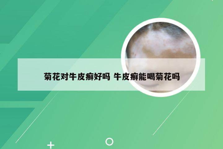 菊花对牛皮癣好吗 牛皮癣能喝菊花吗
