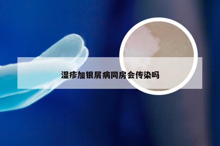 湿疹加银屑病同房会传染吗