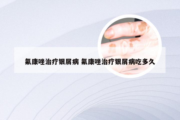 氟康唑治疗银屑病 氟康唑治疗银屑病吃多久
