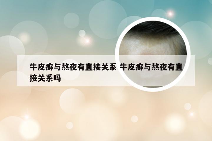 牛皮癣与熬夜有直接关系 牛皮癣与熬夜有直接关系吗