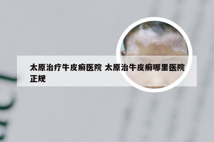 太原治疗牛皮癣医院 太原治牛皮癣哪里医院正规