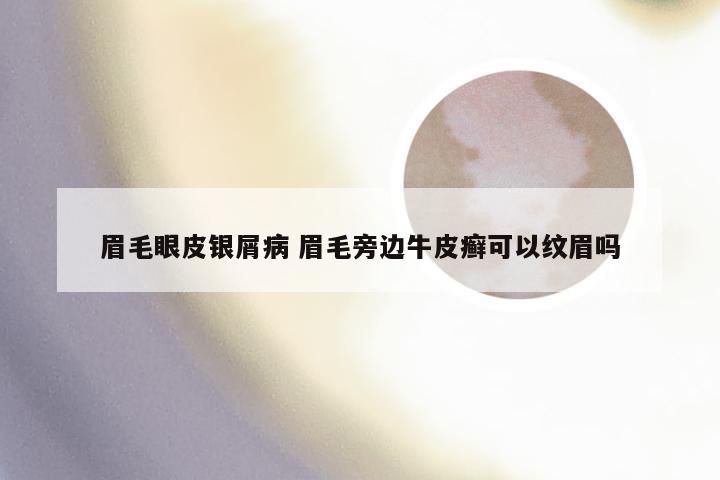 眉毛眼皮银屑病 眉毛旁边牛皮癣可以纹眉吗