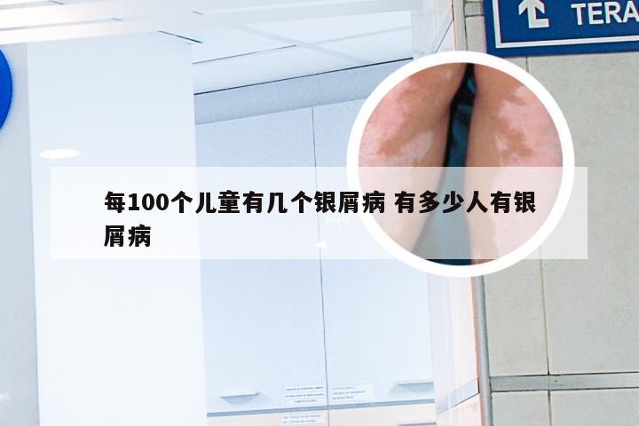 每100个儿童有几个银屑病 有多少人有银屑病
