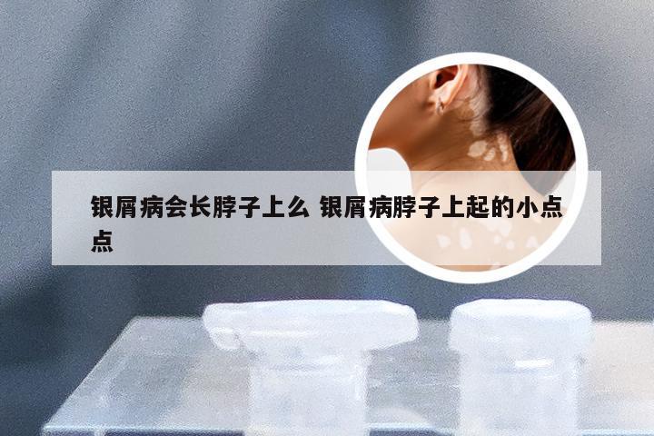 银屑病会长脖子上么 银屑病脖子上起的小点点