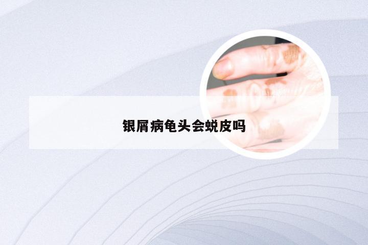 银屑病龟头会蜕皮吗