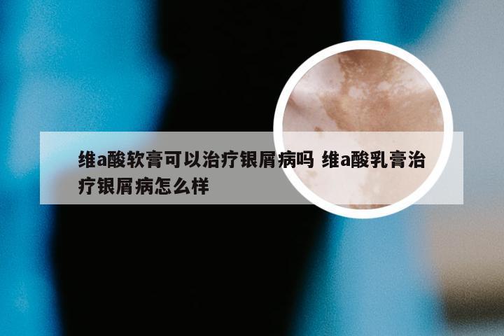 维a酸软膏可以治疗银屑病吗 维a酸乳膏治疗银屑病怎么样