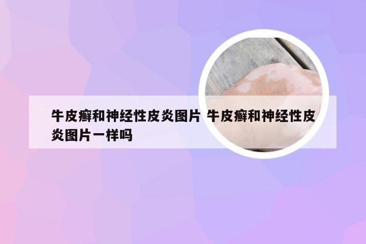 牛皮癣和神经性皮炎图片 牛皮癣和神经性皮炎图片一样吗