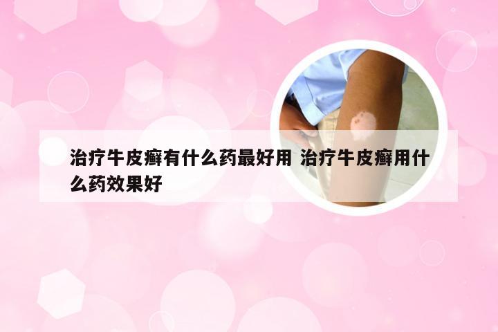 治疗牛皮癣有什么药最好用 治疗牛皮癣用什么药效果好