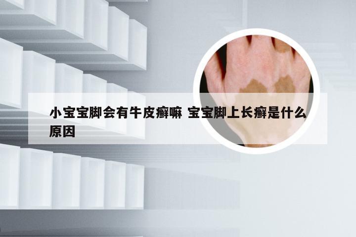 小宝宝脚会有牛皮癣嘛 宝宝脚上长癣是什么原因