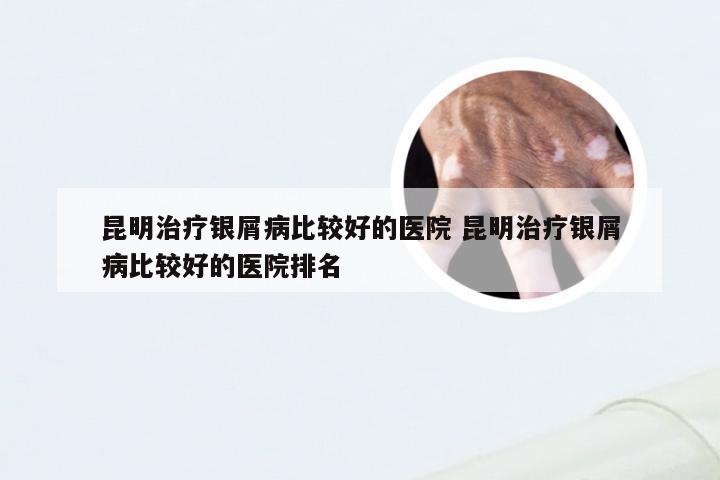 昆明治疗银屑病比较好的医院 昆明治疗银屑病比较好的医院排名