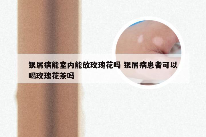 银屑病能室内能放玫瑰花吗 银屑病患者可以喝玫瑰花茶吗