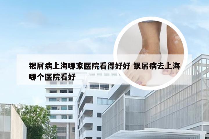 银屑病上海哪家医院看得好好 银屑病去上海哪个医院看好