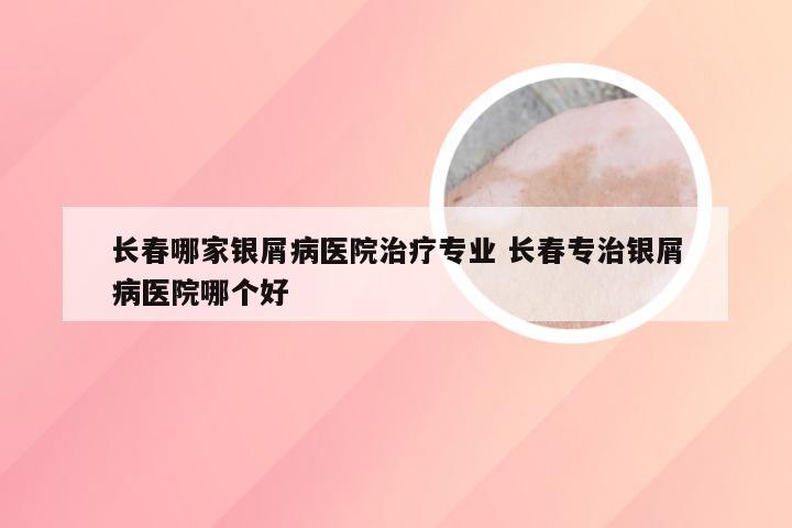 长春哪家银屑病医院治疗专业 长春专治银屑病医院哪个好