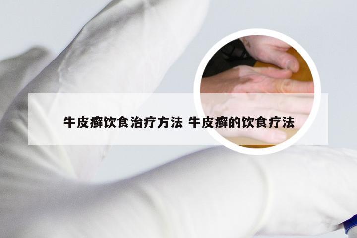 牛皮癣饮食治疗方法 牛皮癣的饮食疗法