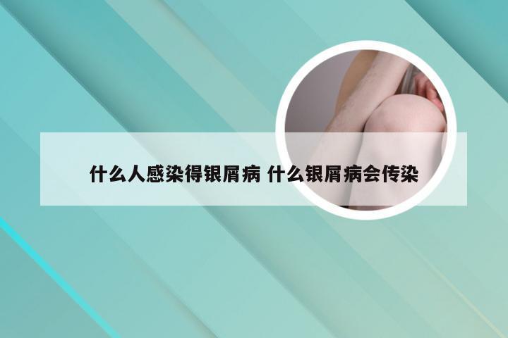 什么人感染得银屑病 什么银屑病会传染