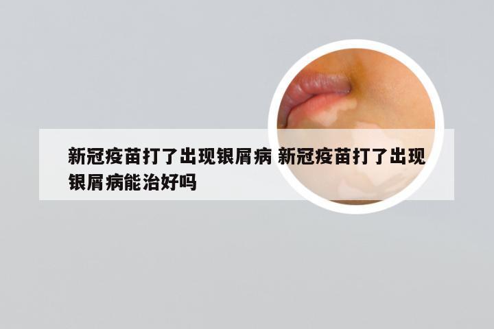 新冠疫苗打了出现银屑病 新冠疫苗打了出现银屑病能治好吗