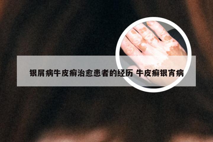 银屑病牛皮癣治愈患者的经历 牛皮癣银宵病
