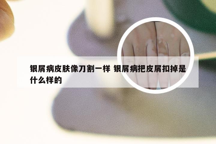 银屑病皮肤像刀割一样 银屑病把皮屑扣掉是什么样的