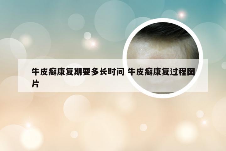 牛皮癣康复期要多长时间 牛皮癣康复过程图片